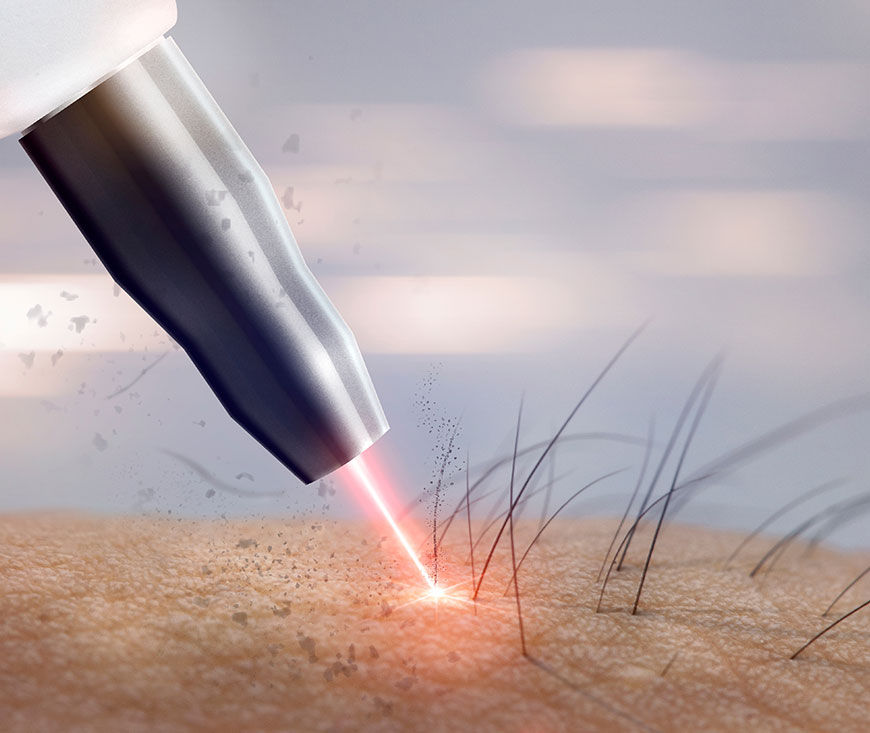 Laser Treatment In Nigeria