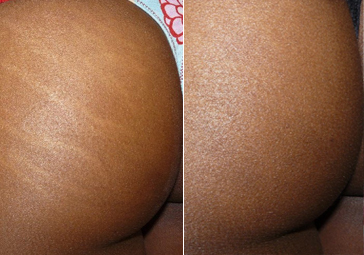 Carboxy Therapy Cellulite & Stretch Mark Reduction in NY