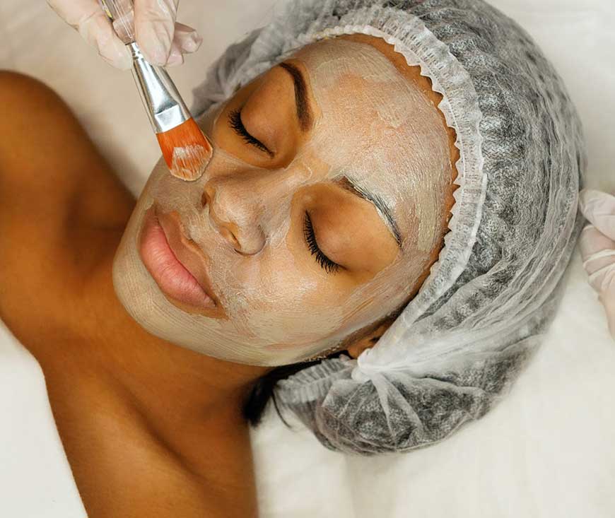 Chemical Peel