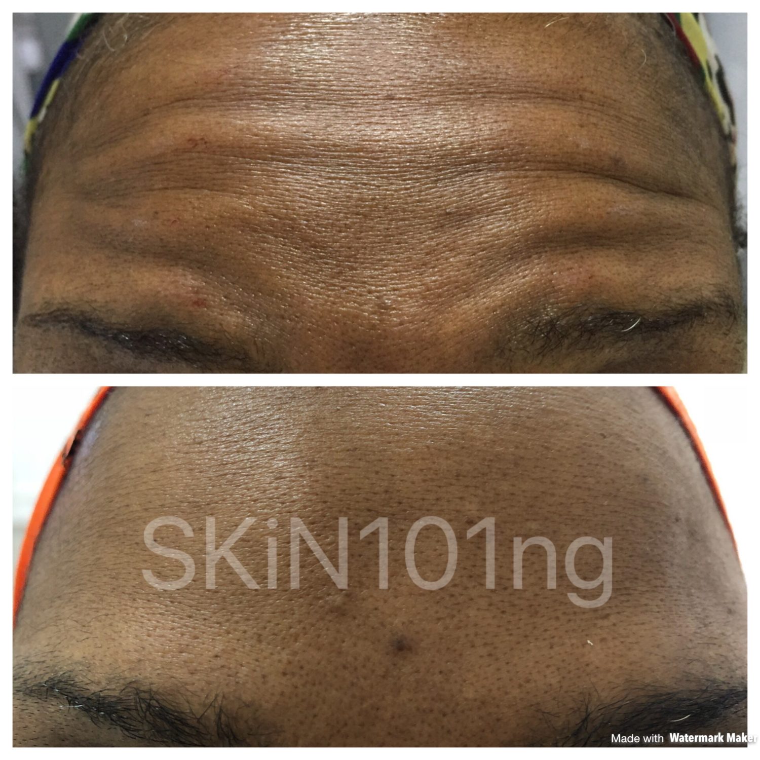 forehead botox treatment