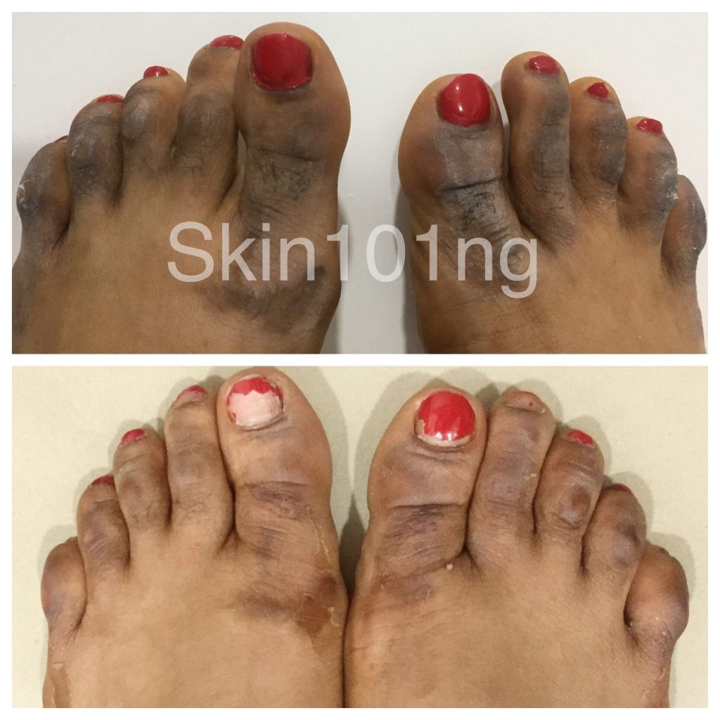 dark-knuckles-treatment-feet-skin101-center