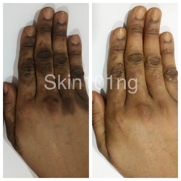 Dark Knuckles Treatment Hands Award Winning Doctor Led Cosmetic Clinics 0710