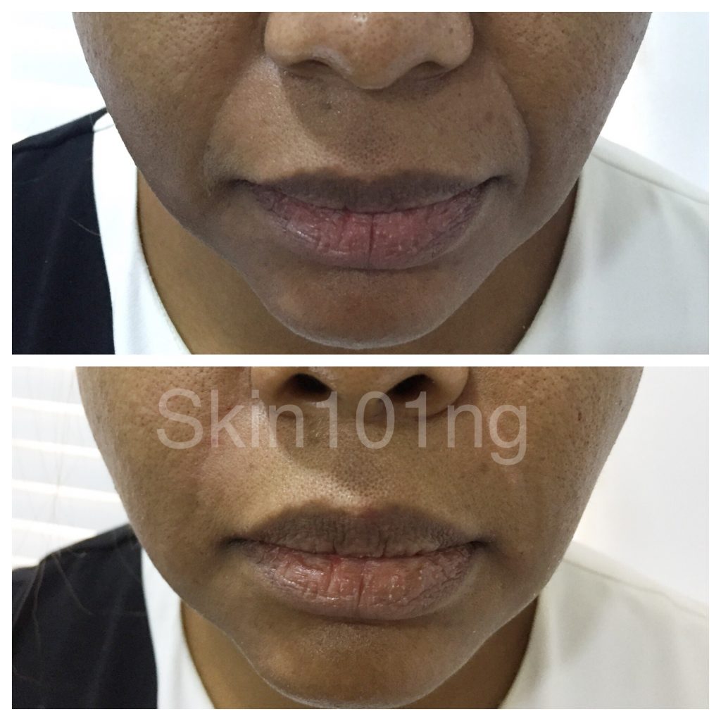 Dermal Fillers For Nasolabial Folds Aka Laugh Lines Treatment Skin101 Center 1223