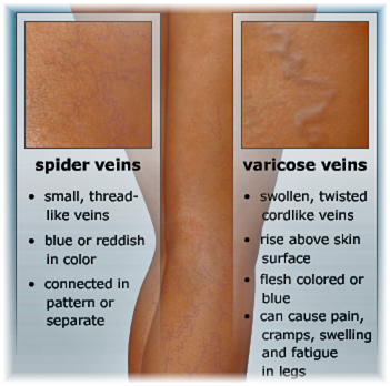 treatment of varicose veins in nigeria - sclerotherapy