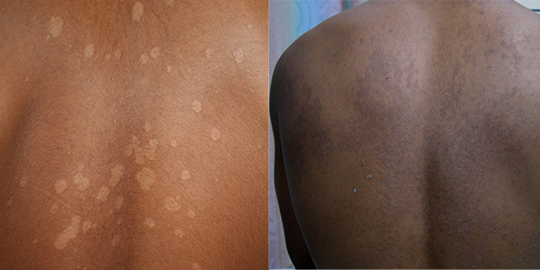 eczema vs pityriasis versicolor