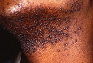Figure 1. Pseudofolliculitis barbae(Photo credit:www.dermapedia.com)