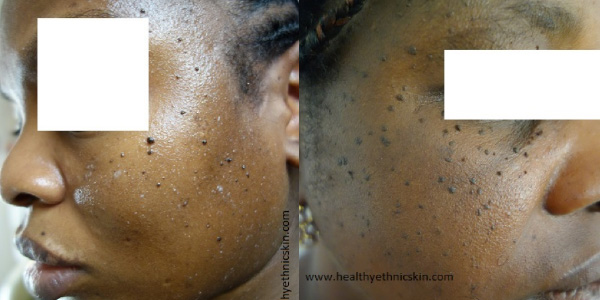 moles or freckles, DPN