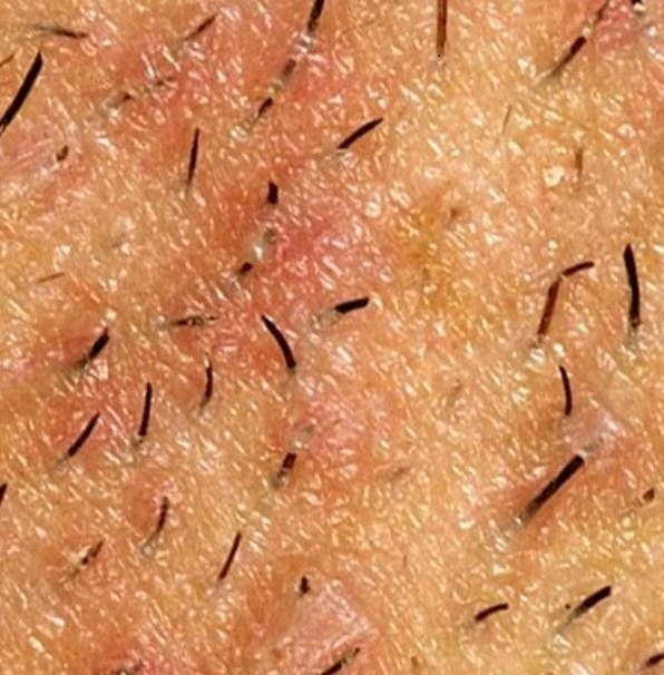 Figure 3. Showing many hair strands growing within and into the skin. Some of them are infected.
