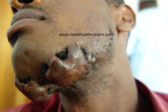 4. A patient of mine with keloids that developed following psuedofolliculitis barbae.