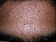 (Photo courtesy gidifab.com) Showing non-inflammed acne with several blackheads and fewer whiteheads.