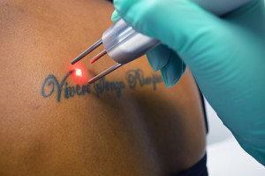 Laser Tattoo Removal