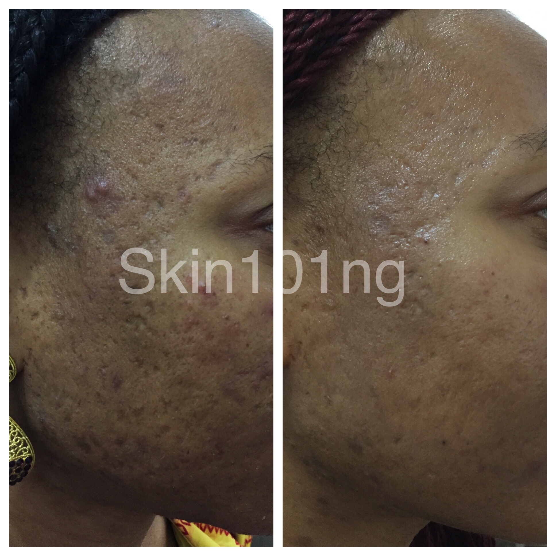 Acne scarring treatment