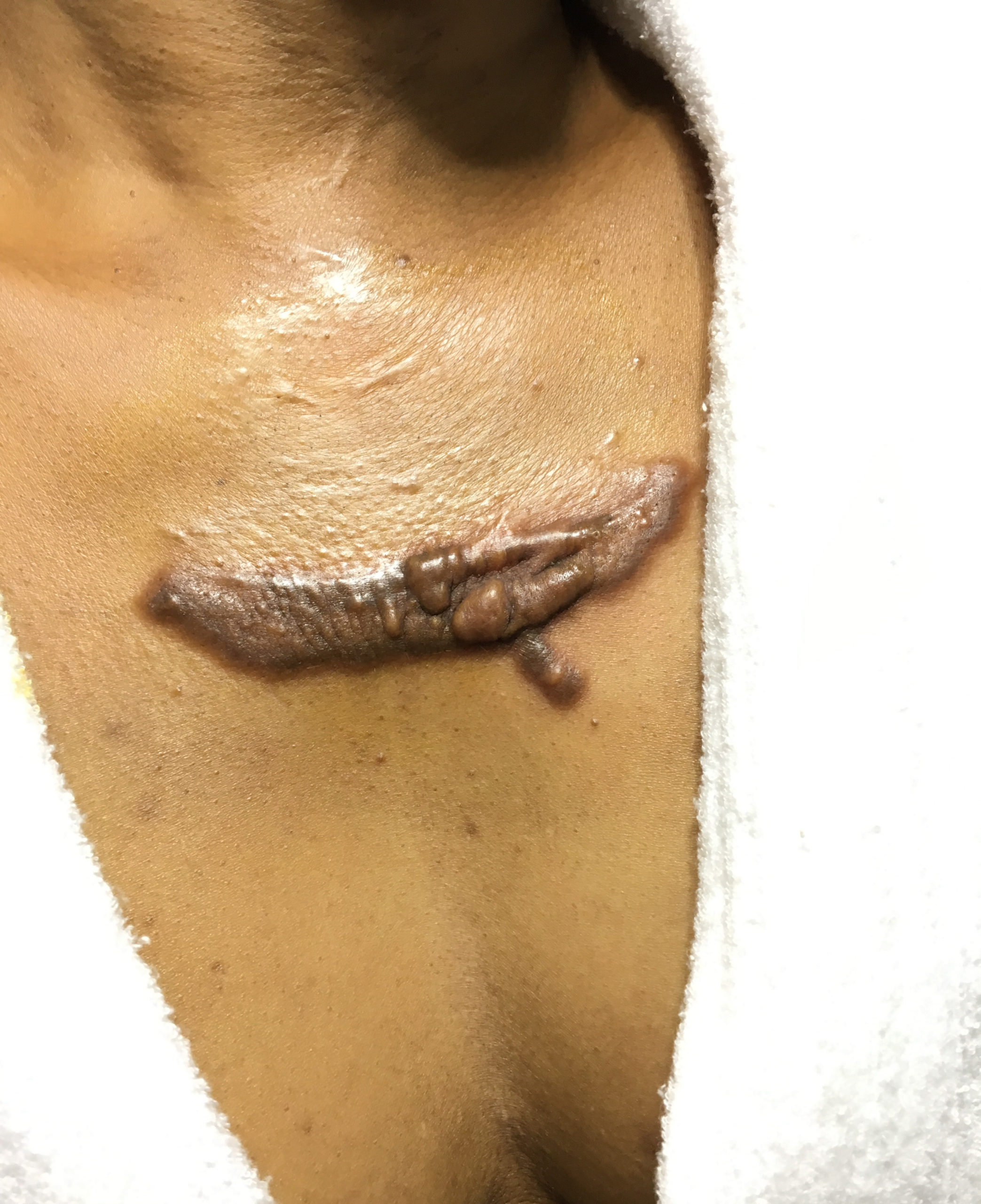 best keloid treatment in nigeria