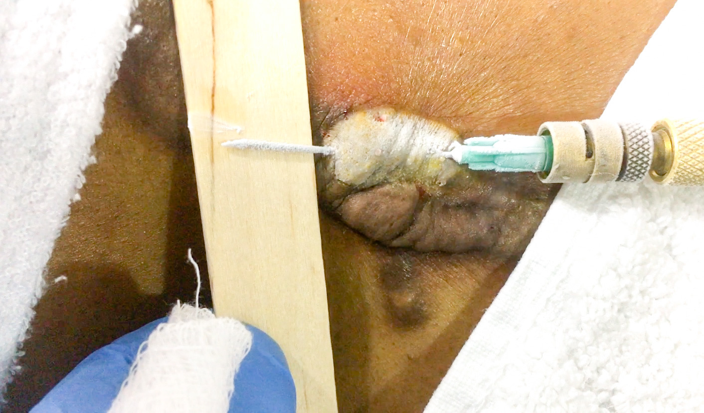 Intralesional cryotherapy keloid treatment in nigeria
