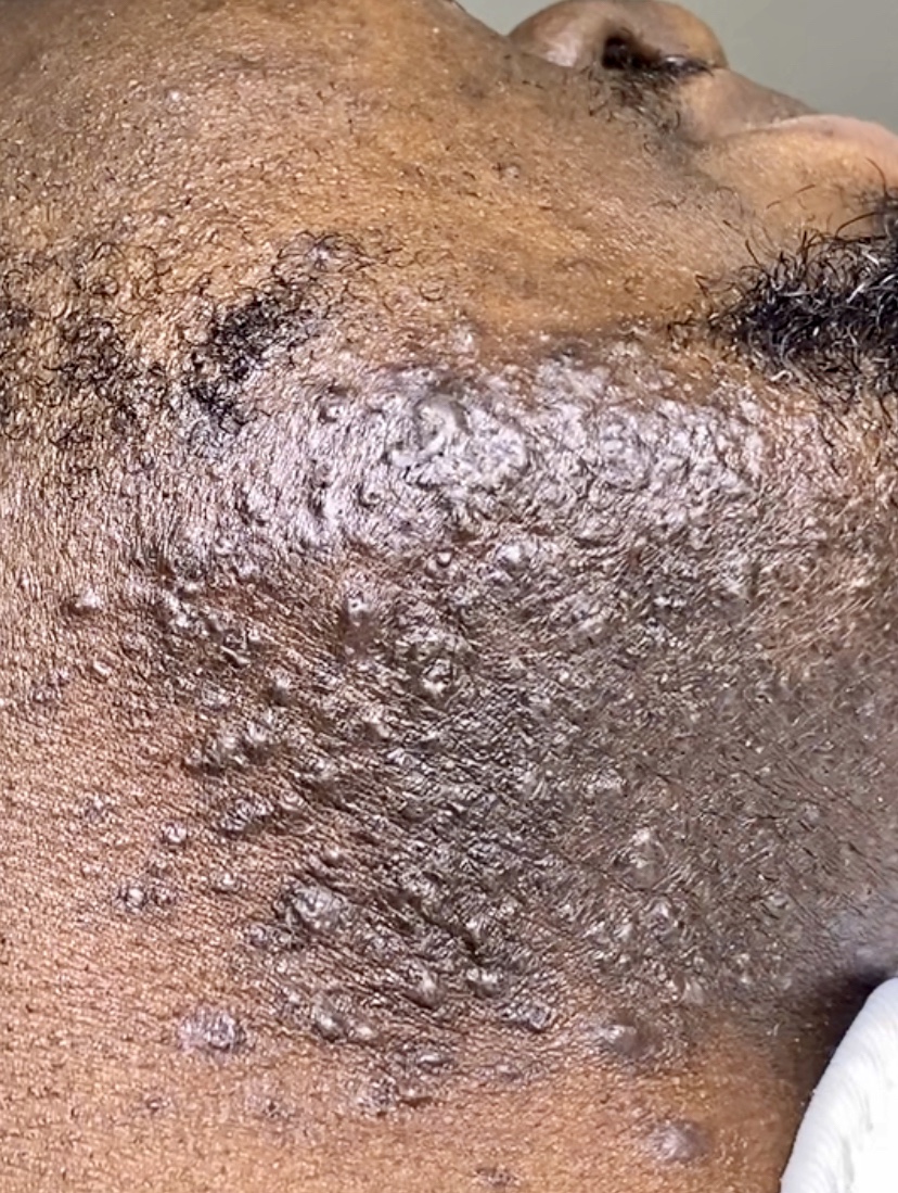 pseudofolliculitis barbae ingrown hair complication