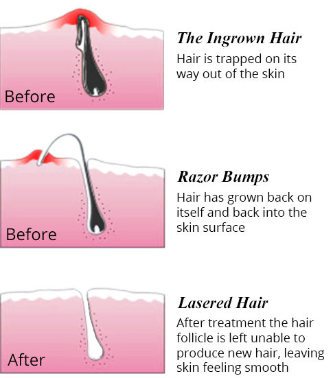 ingrown hair removal