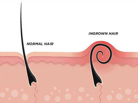 Best Ingrown Hair Treatment Laser Hair Removal