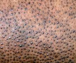 Keratosis Pilaris treatment nigeria