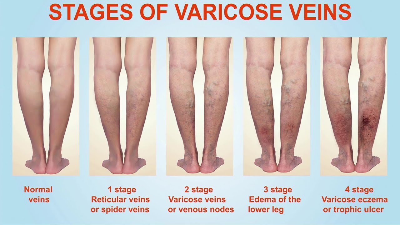 stages of varicose veins and treatment of varicose veins in Nigeria