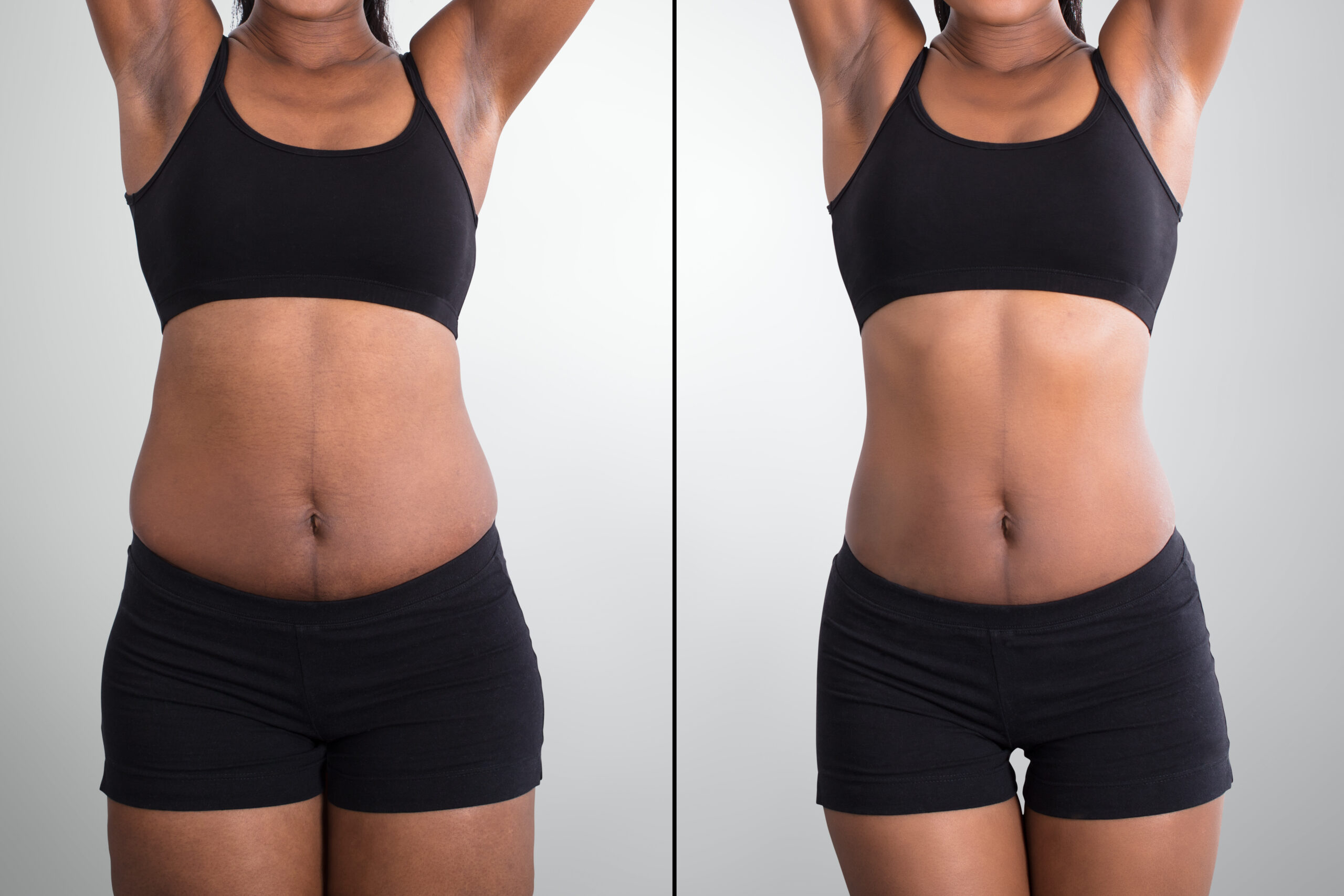 Abdominal Liposuction  Stomach, Belly, Tummy Lipo Procedures