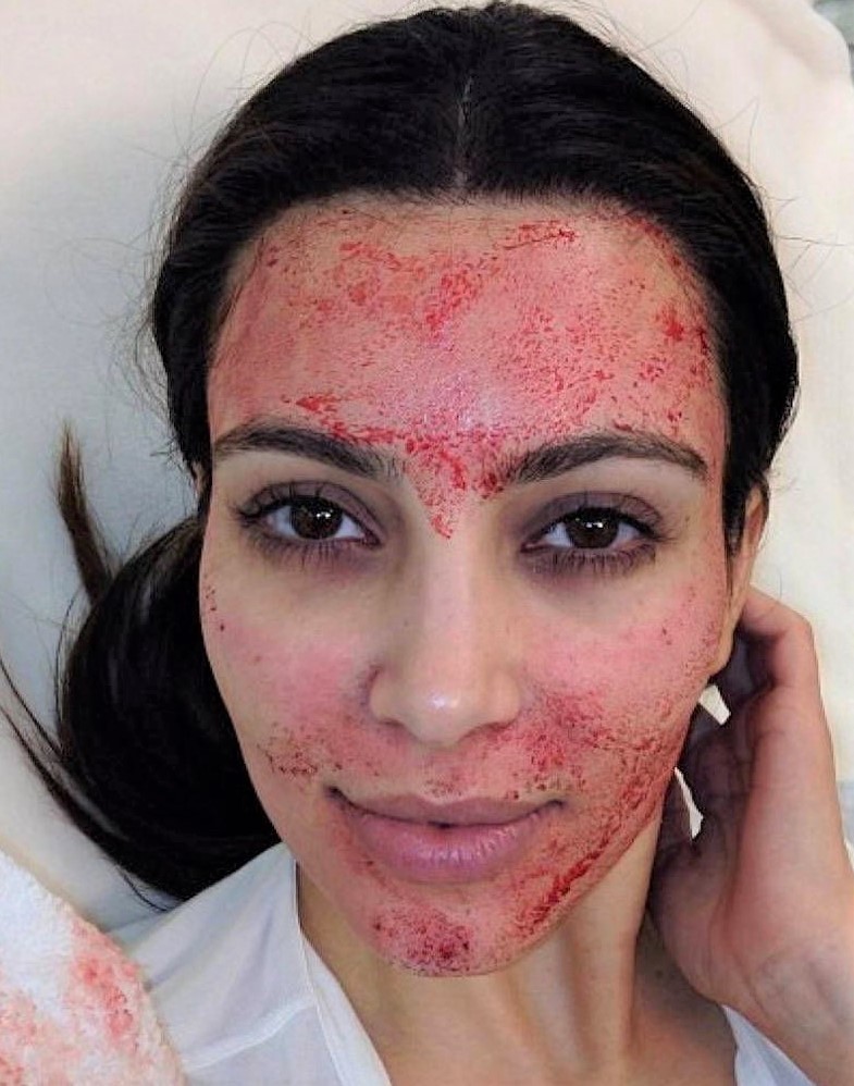 Vampire facial microneedling with PRP on kim kardashian