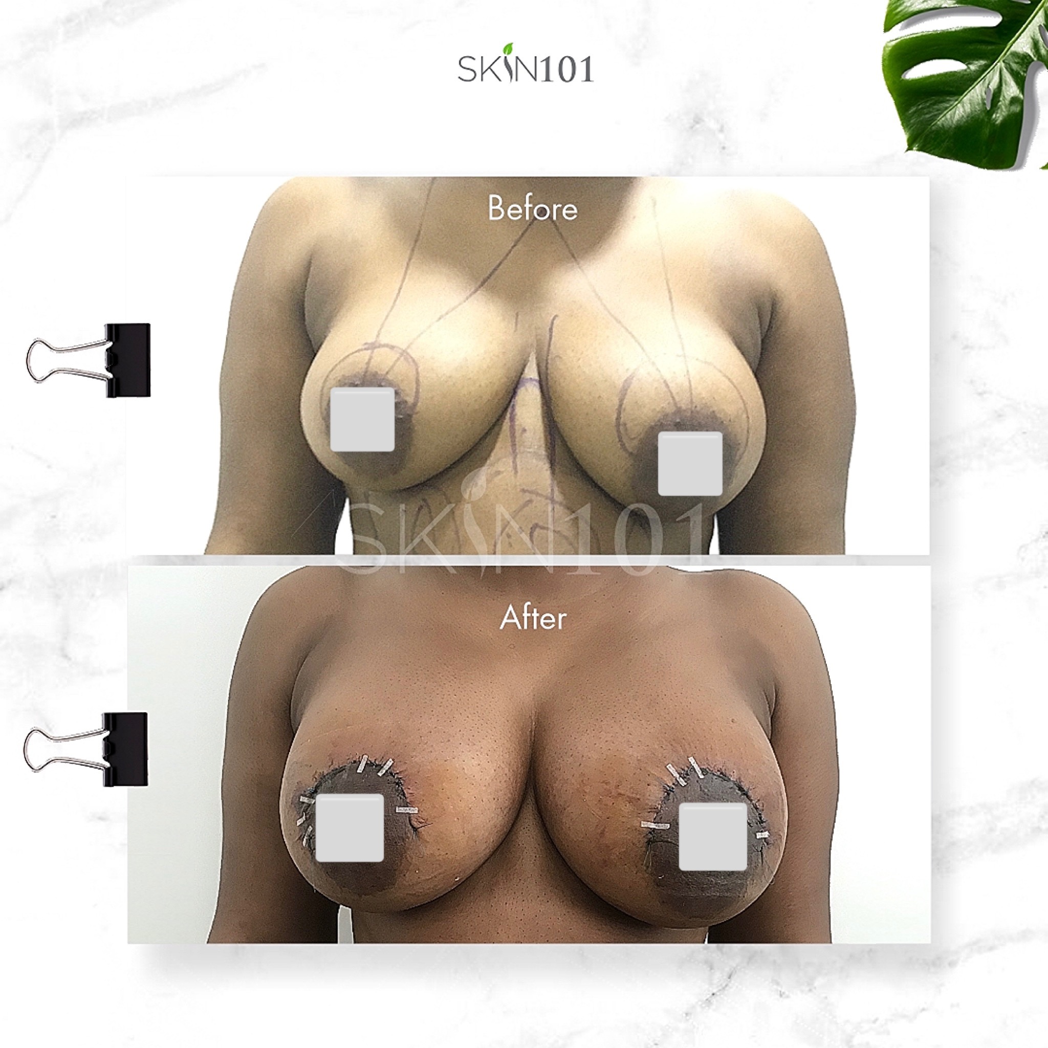 Before & After - Skin101 Center