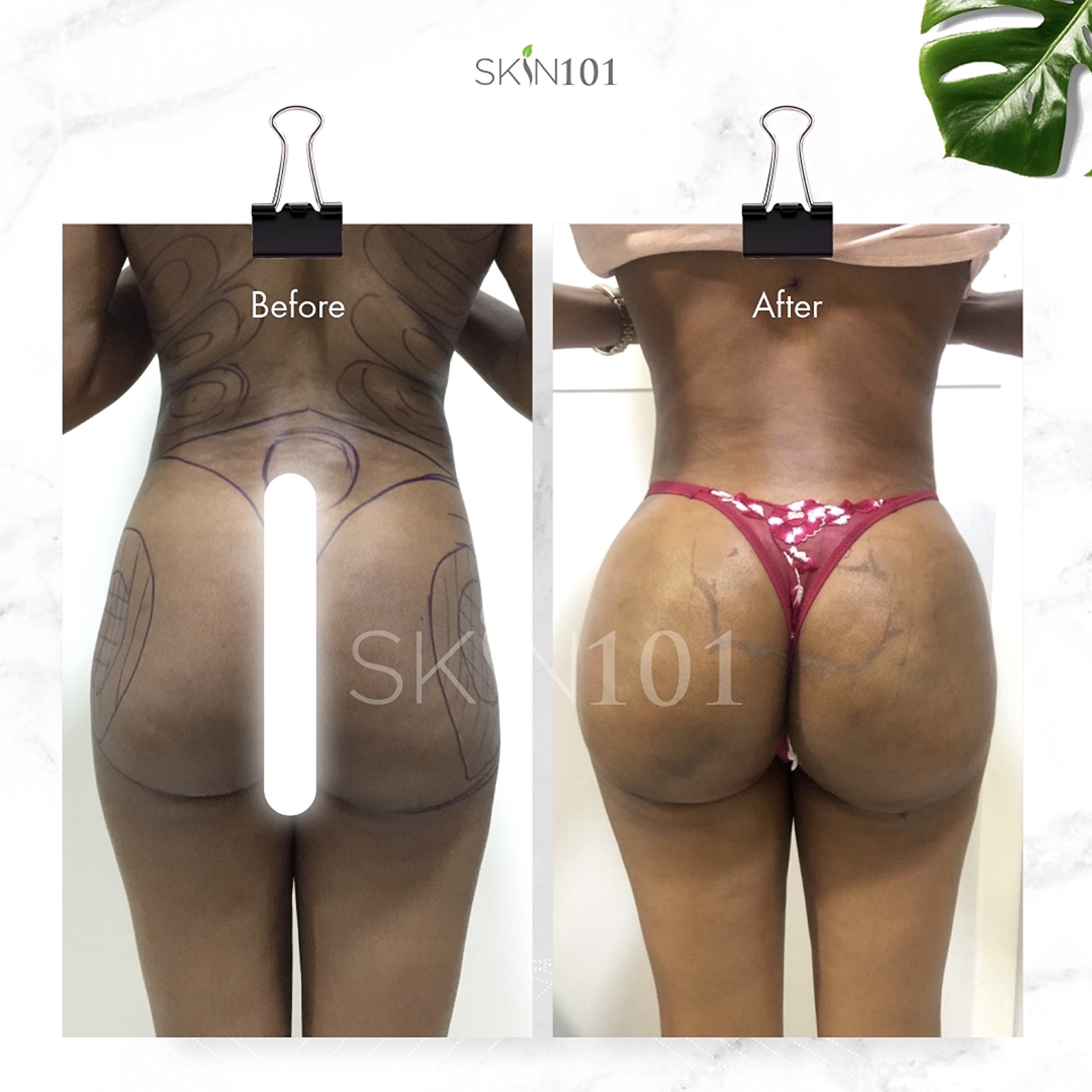 fat transfer to buttocks brazilian butt lift in nigeria before and after