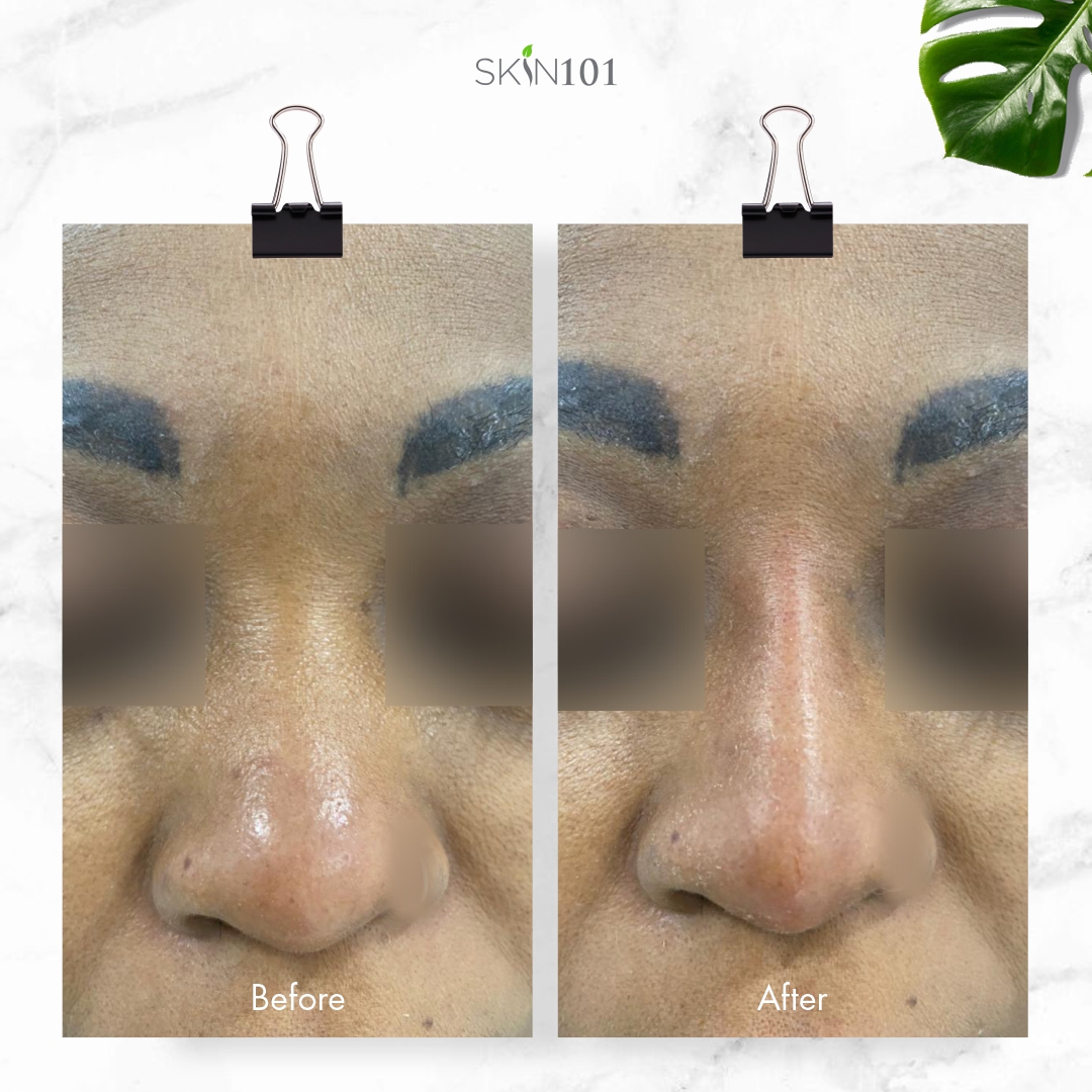 Liquid Rhinoplasty AKA Nose Fillers - Before And After