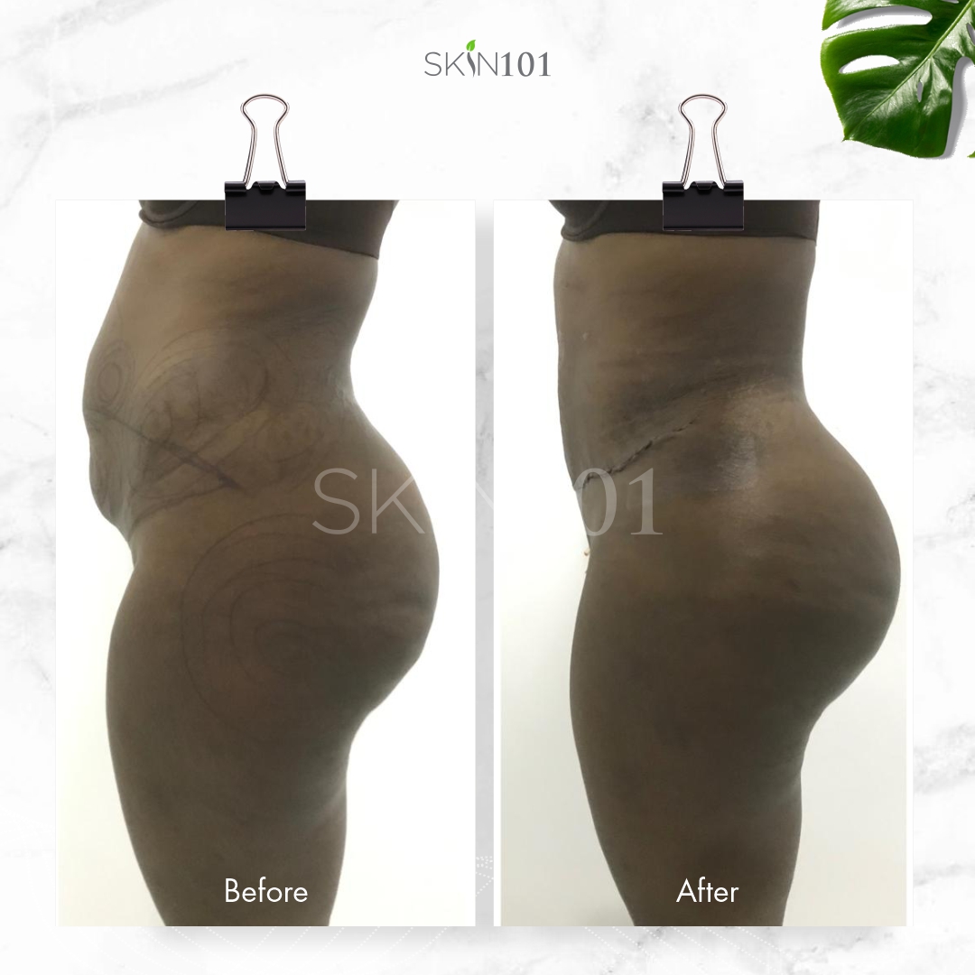 Tummy Tuck Before And After - Skin101 Center