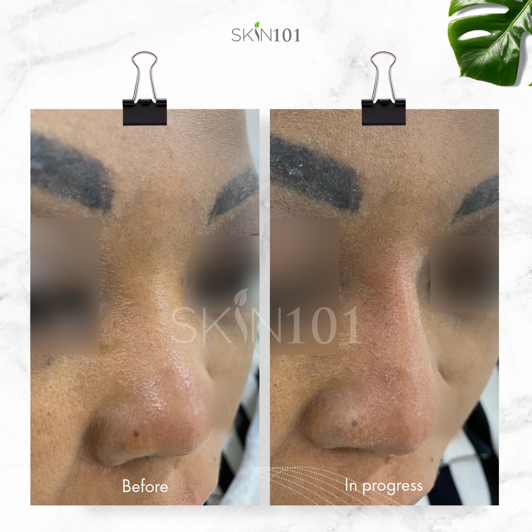 Nonsurgical nose job with Nose fillers before and after
