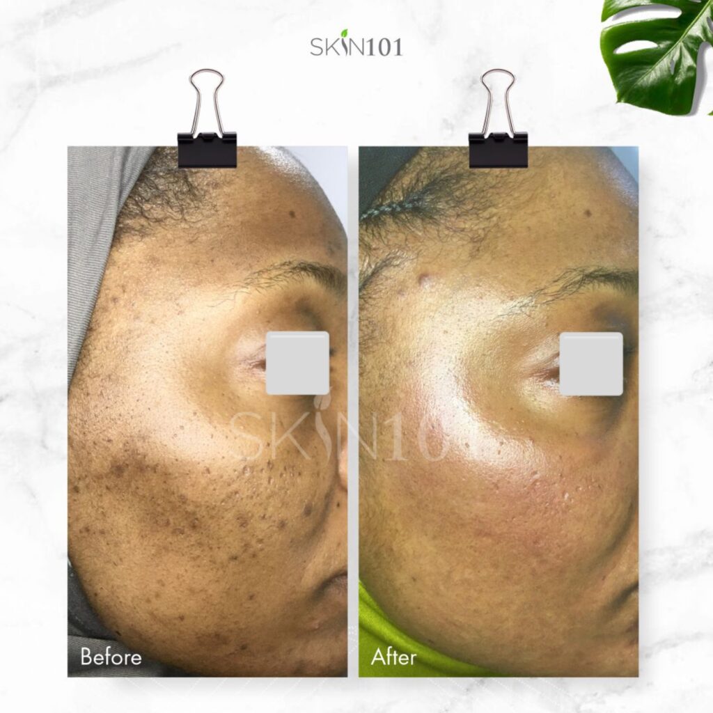 Post Inflammatory Hyperpigmentation PIH From Acne - Before And After ...