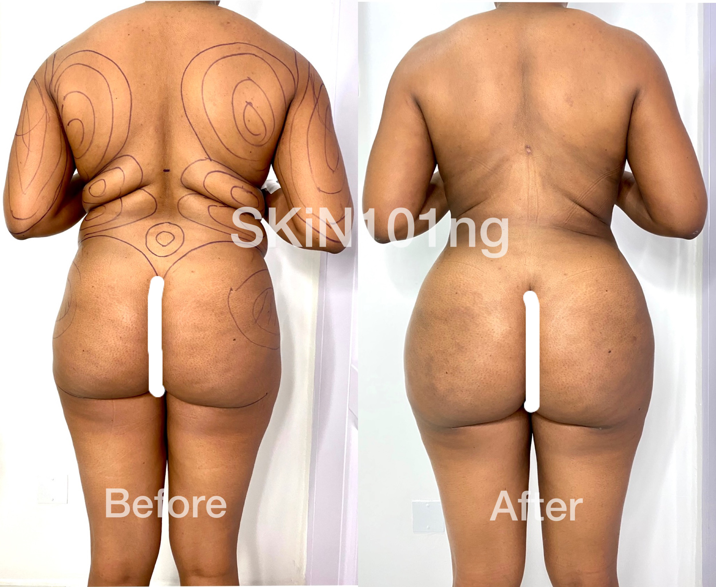 Butt Lift Via Fat Transfer To Buttocks - Skin101 Center