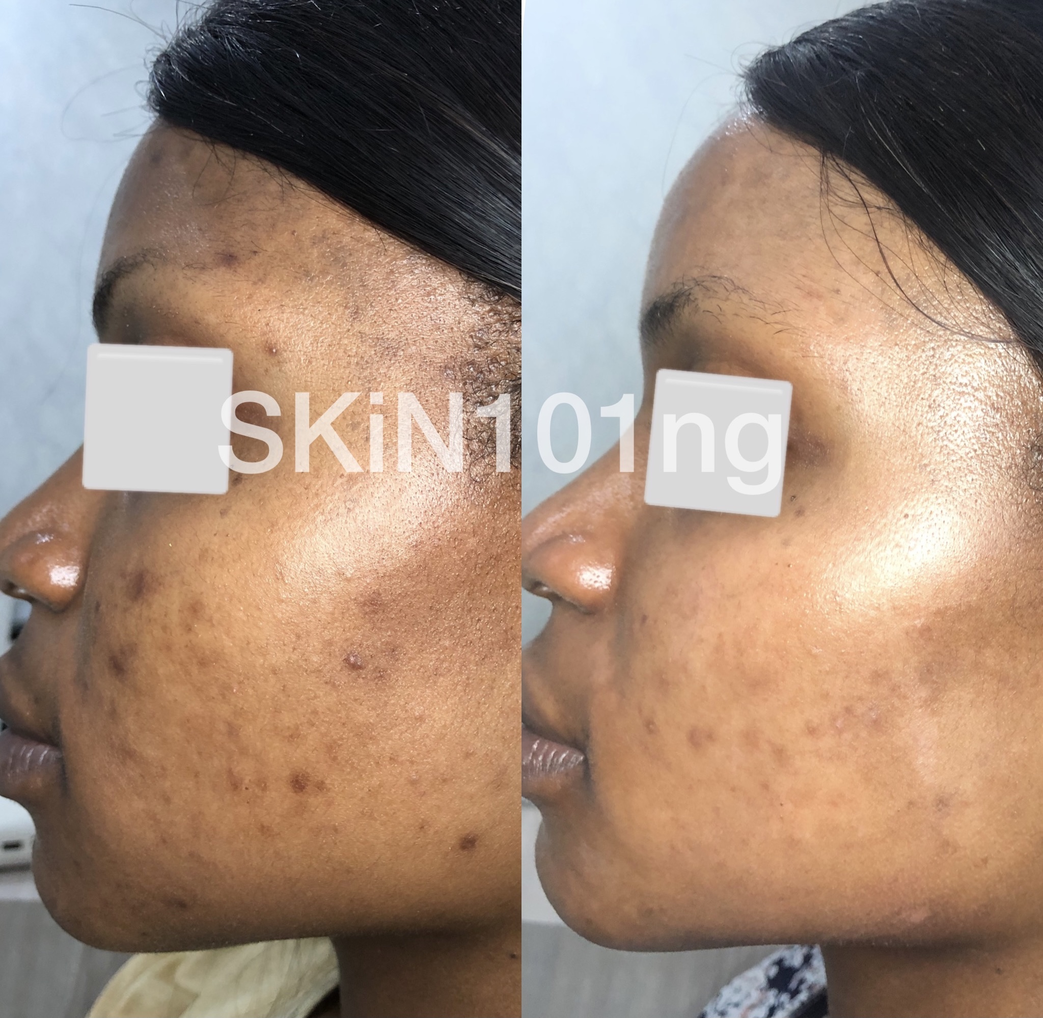 treatment of PIH from acne Before And After photo