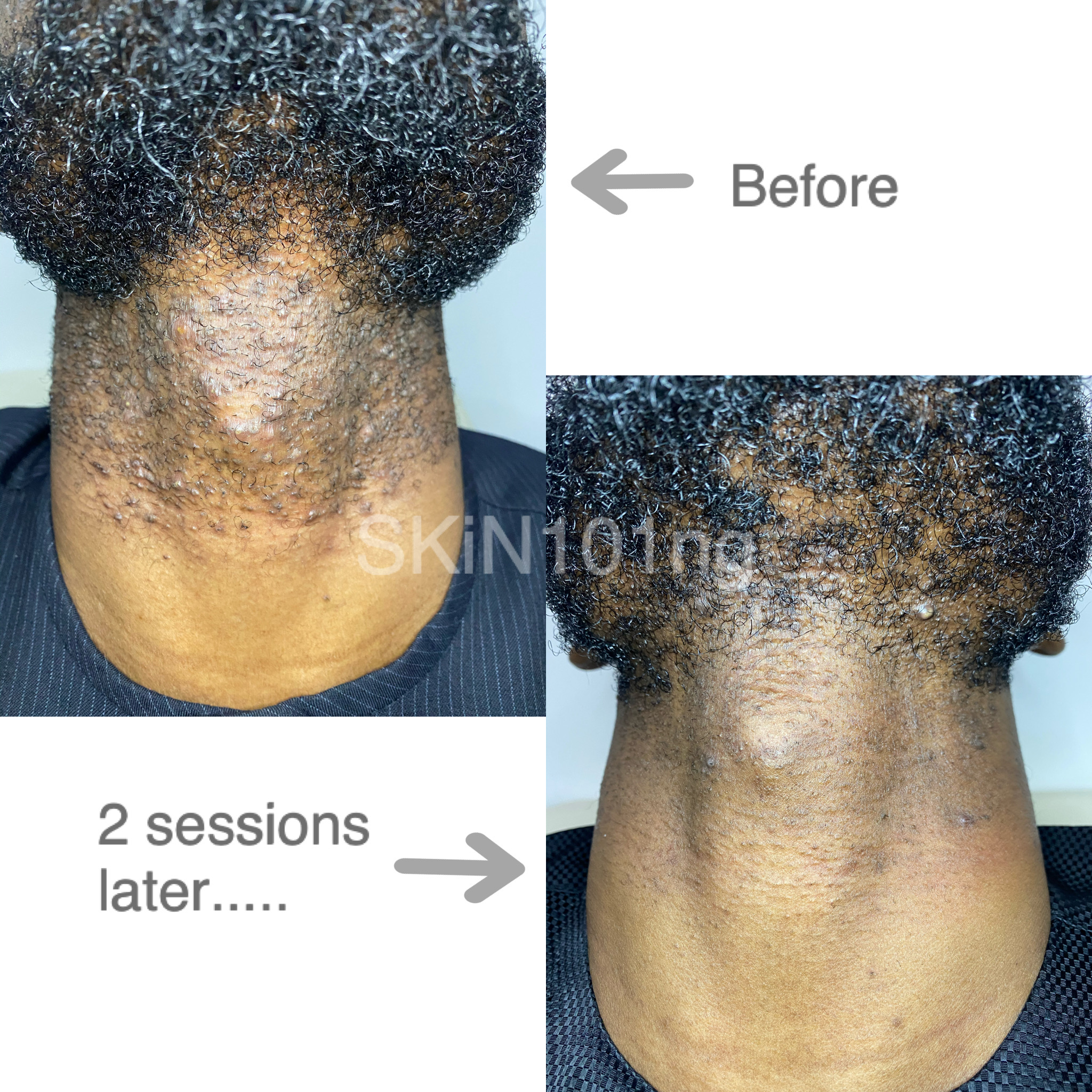 Pseudofolliculitis barbae shave bumps before and after laser hair reduction