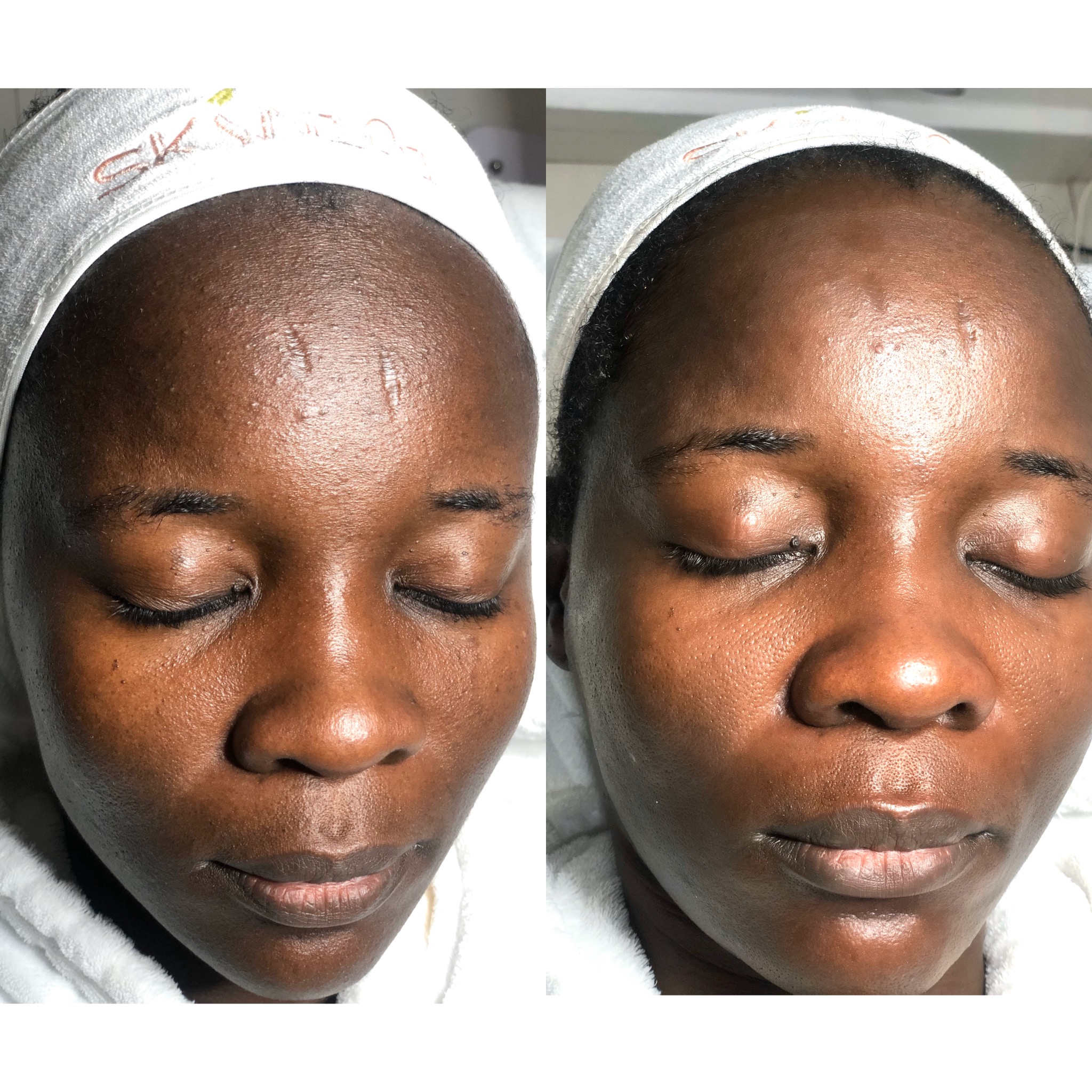 Before and after of luminous brightening facial