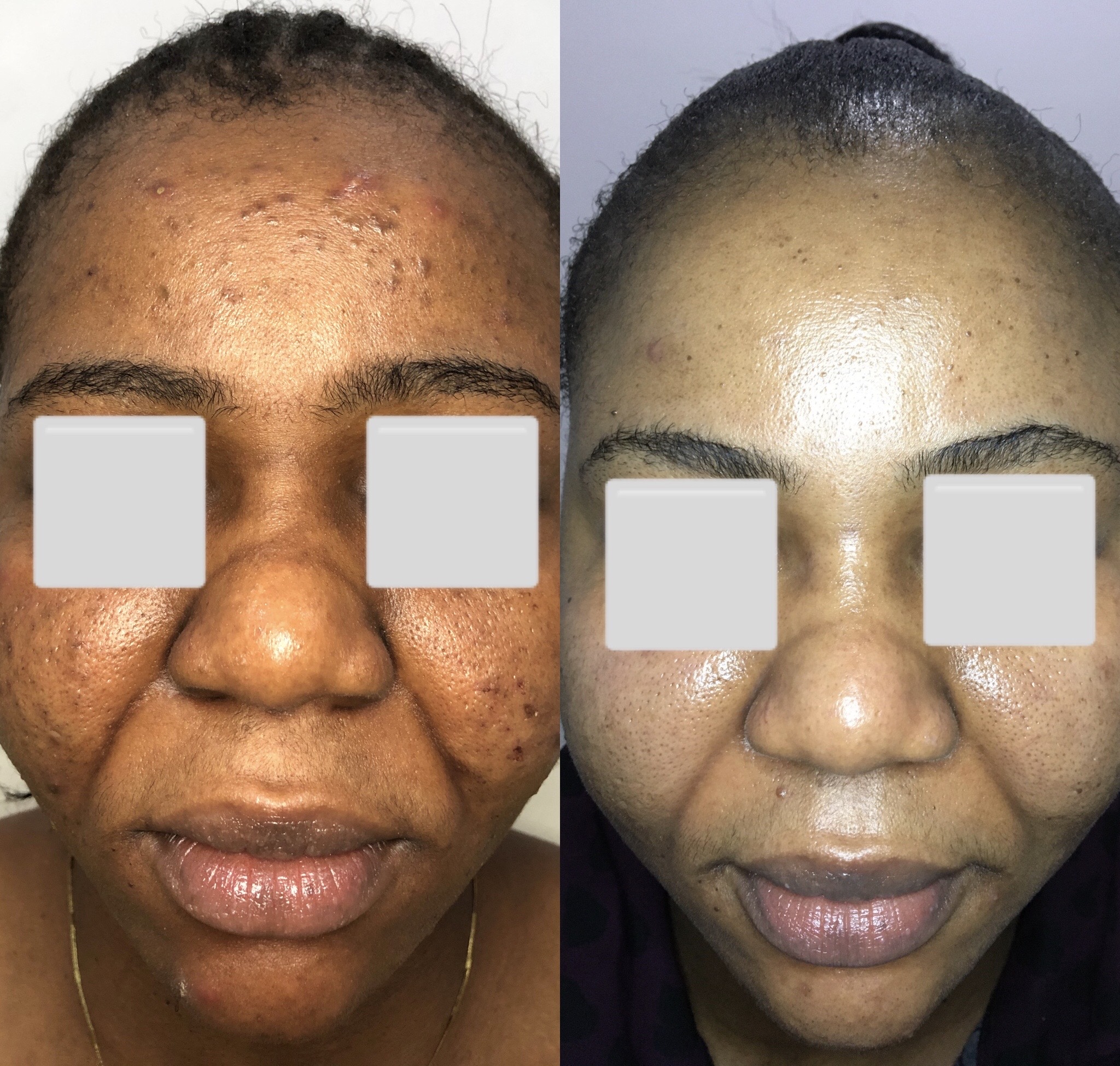 Before and after a chemical peel 3