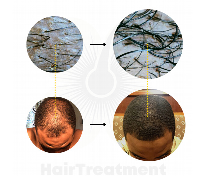Hair Transplant in Abuja Nigeria