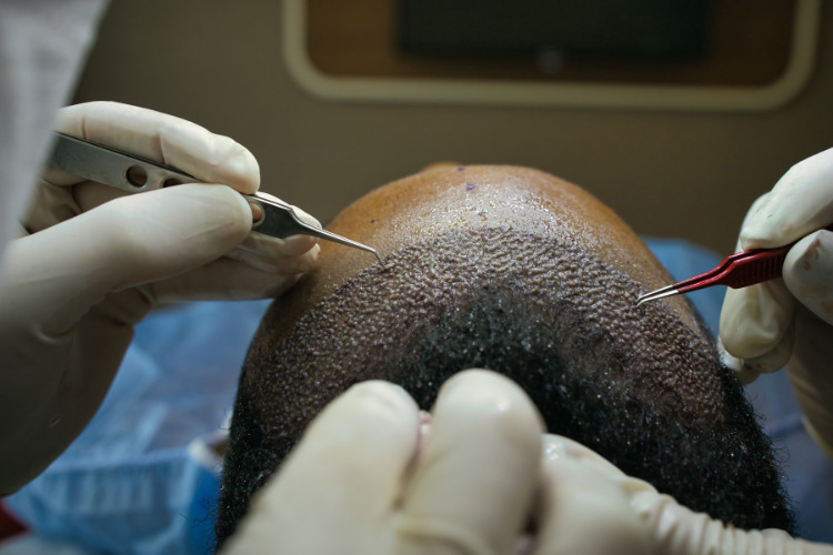 Hair Transplant Surgery