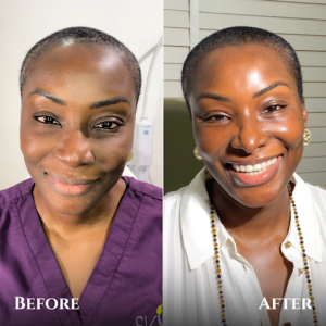 Before and after pictures of Glass Skin Treatment