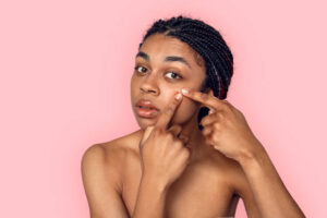 Managing Hormonal Acne