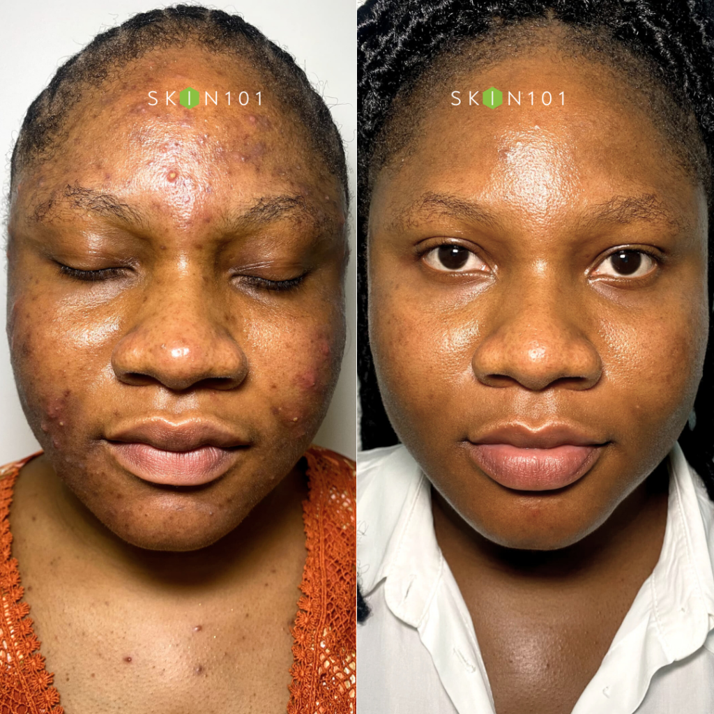 Acne Treatment At Dermatologist in Abuja, before and after pictures