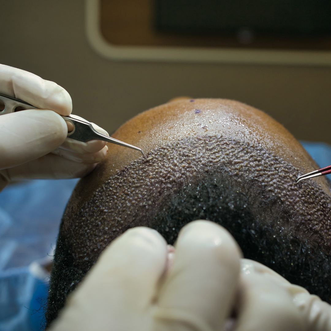 Things to consider before getting a hair transplant in Nigeria