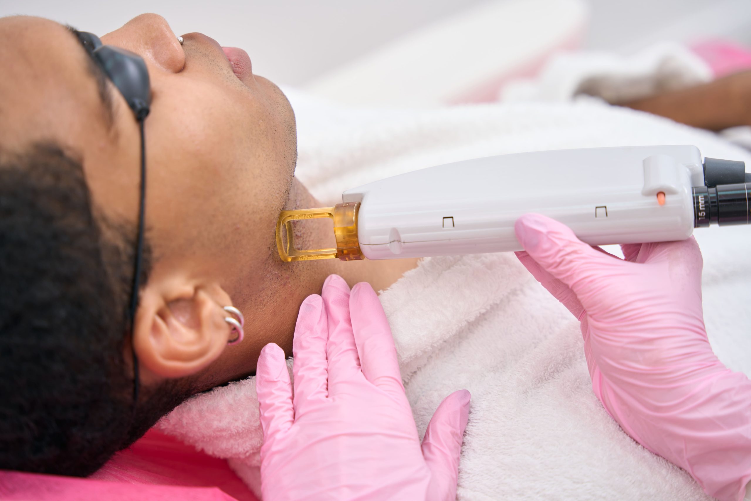 Microneedling PRP and rejuvenation at Skin101